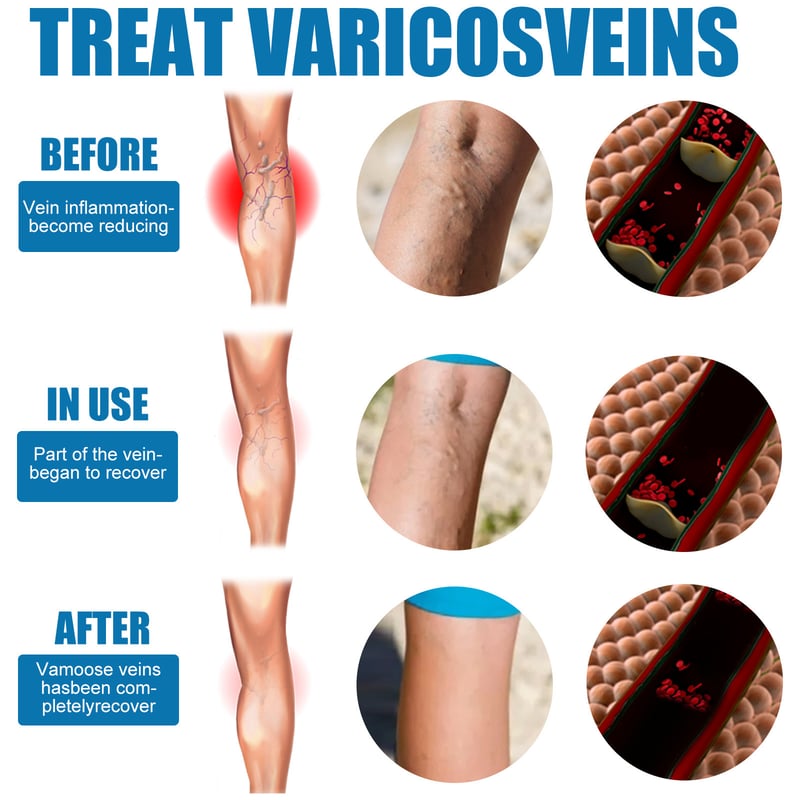 Varicose Veins Spray✨Professional Spray To Restore Healthy Legs! YT2