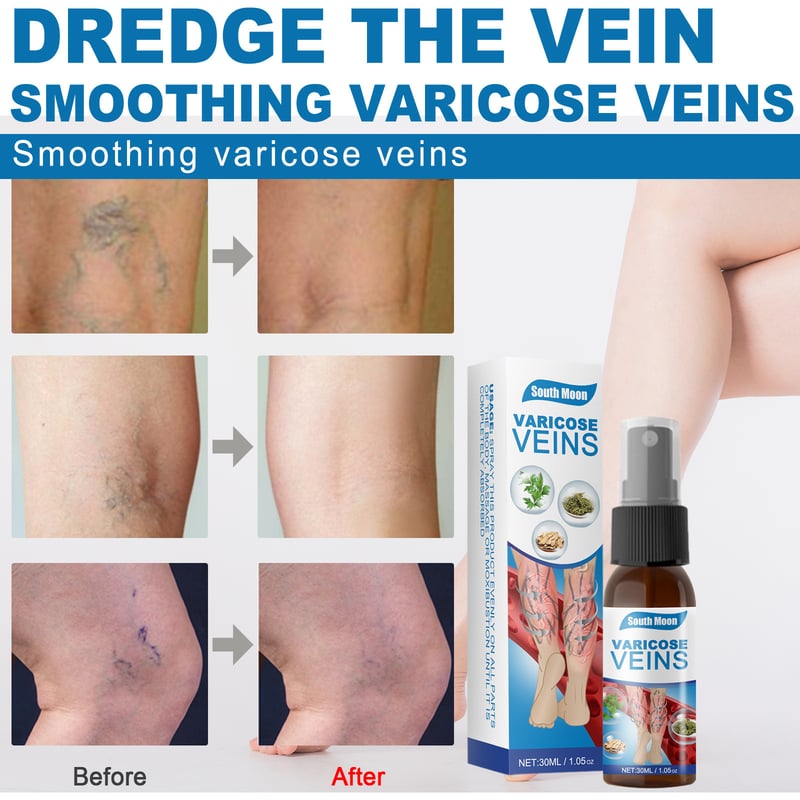Varicose Veins Spray✨Professional Spray To Restore Healthy Legs! YT2