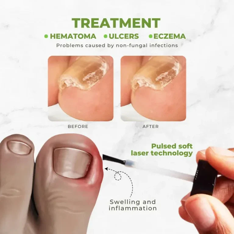 FungiVanish Bee Venom Nail Treatment Oil yt 2