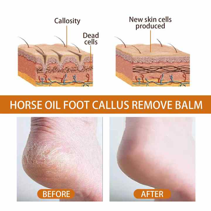 Horse Oil Foot Callus Remedy Balm